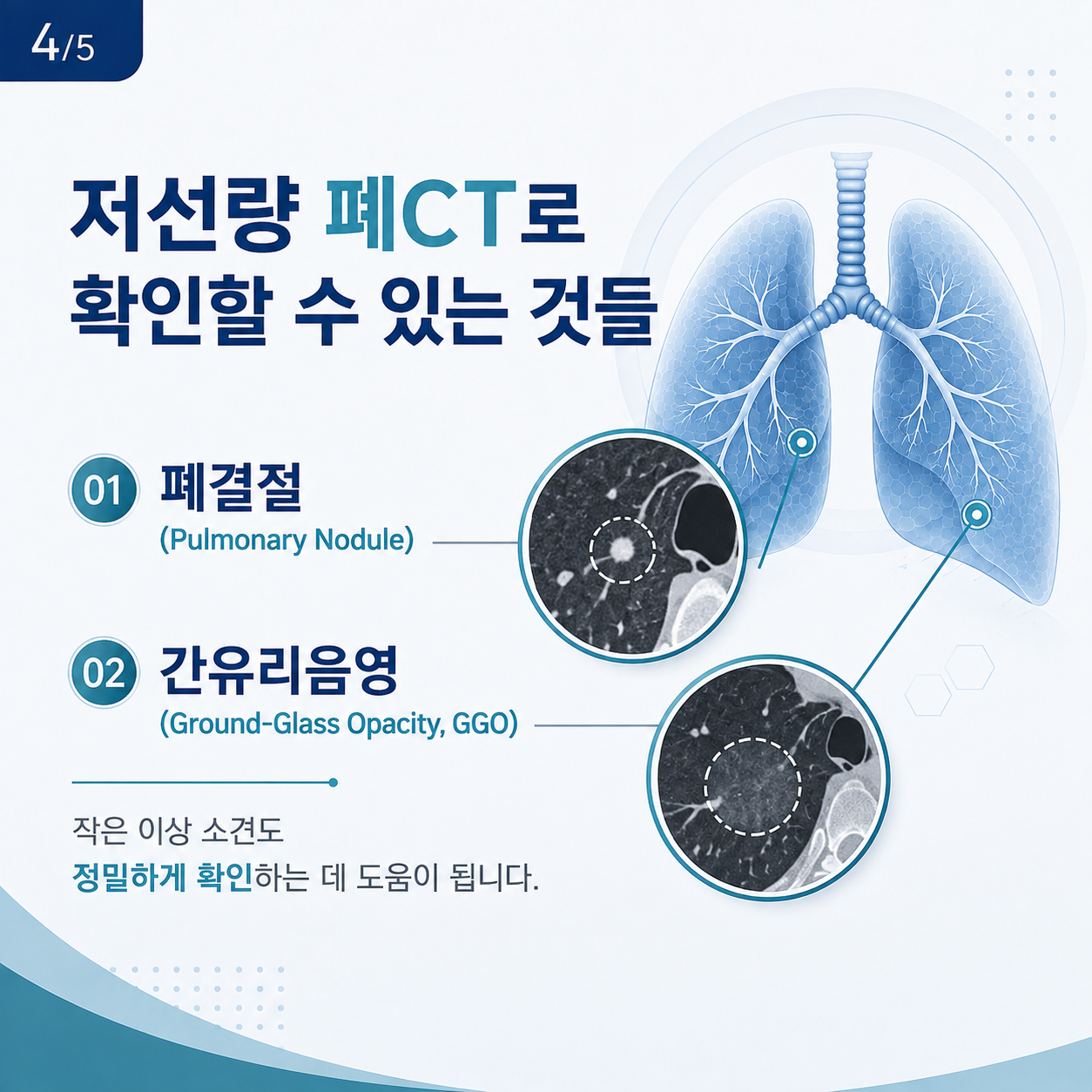 폐ct2.png