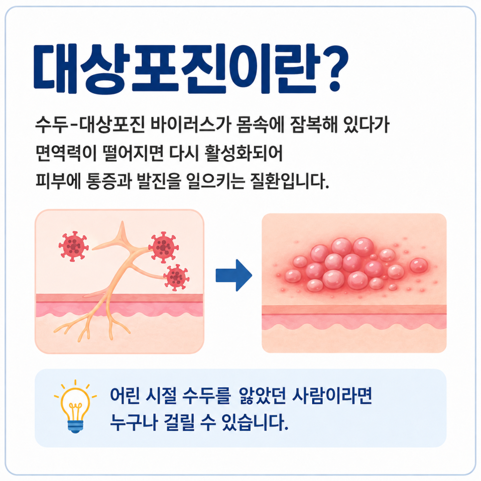 대상포진.png