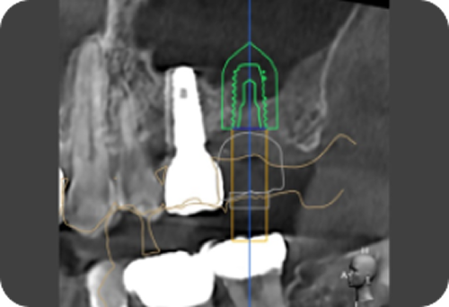 구월동 뉴욕치과 디지털 임플란트 1단계 3D CT 구강 상태 진단