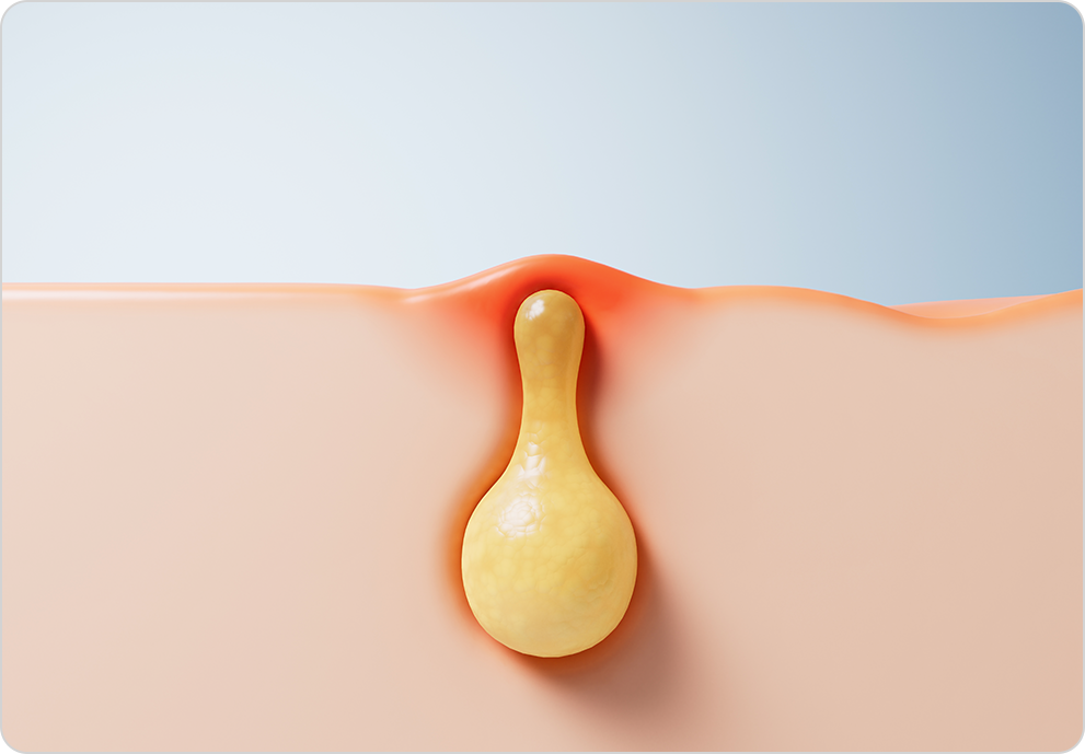 치루 및 농양 증상 3