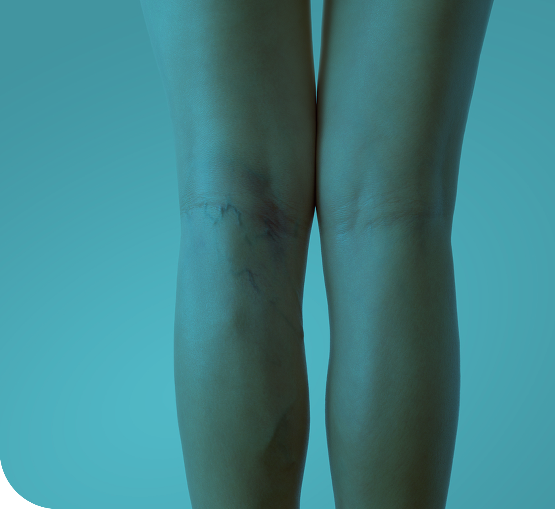 하지정맥류로 인해 다리에 불편함을 느끼는 모습