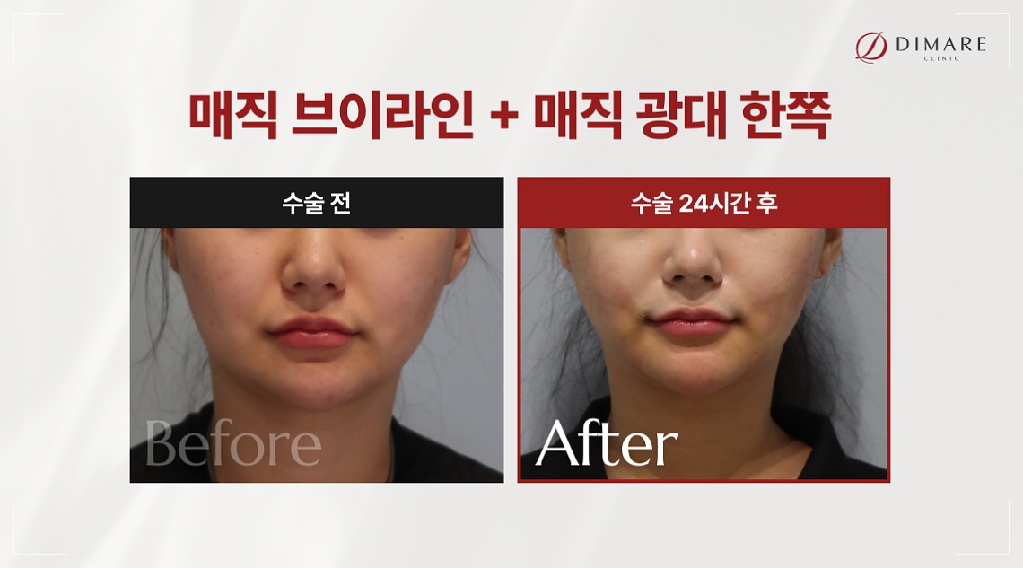 광대 시술 얼굴 면적 줄이기 디마레클리닉 광대지방흡입 전후사진